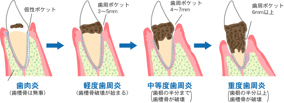 歯周病の治療法