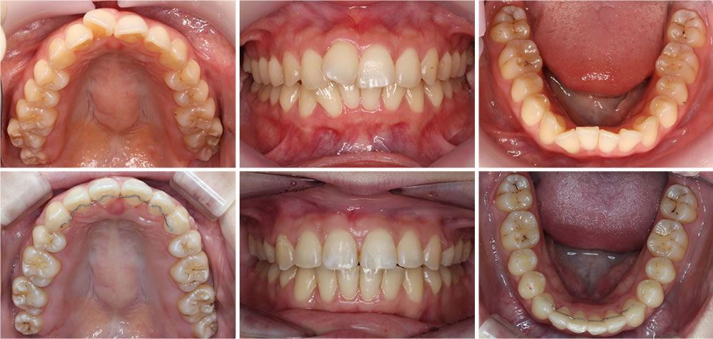 上顎の部分矯正治療症例